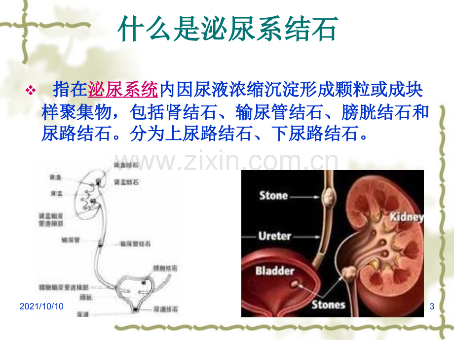 泌尿结石病人饮食指导.ppt_第3页