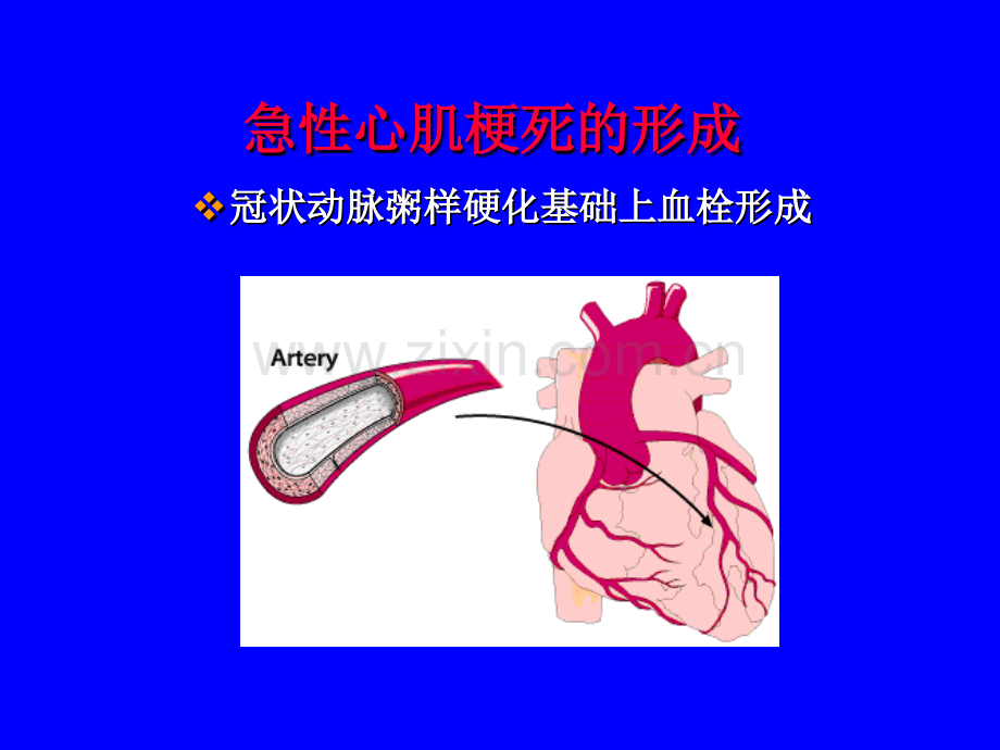 急性心肌梗死的心电图(讲课).ppt_第3页