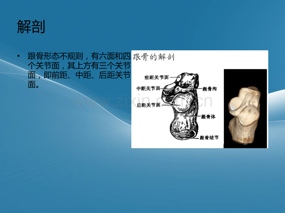 跟骨骨折.ppt_第3页