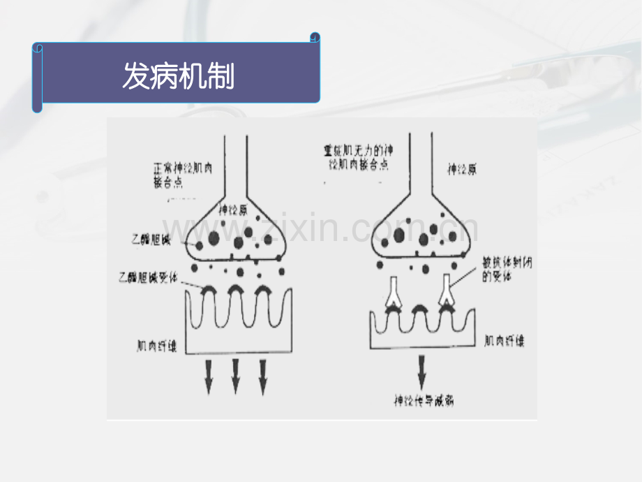 罗辰颖重症肌无力.ppt_第3页