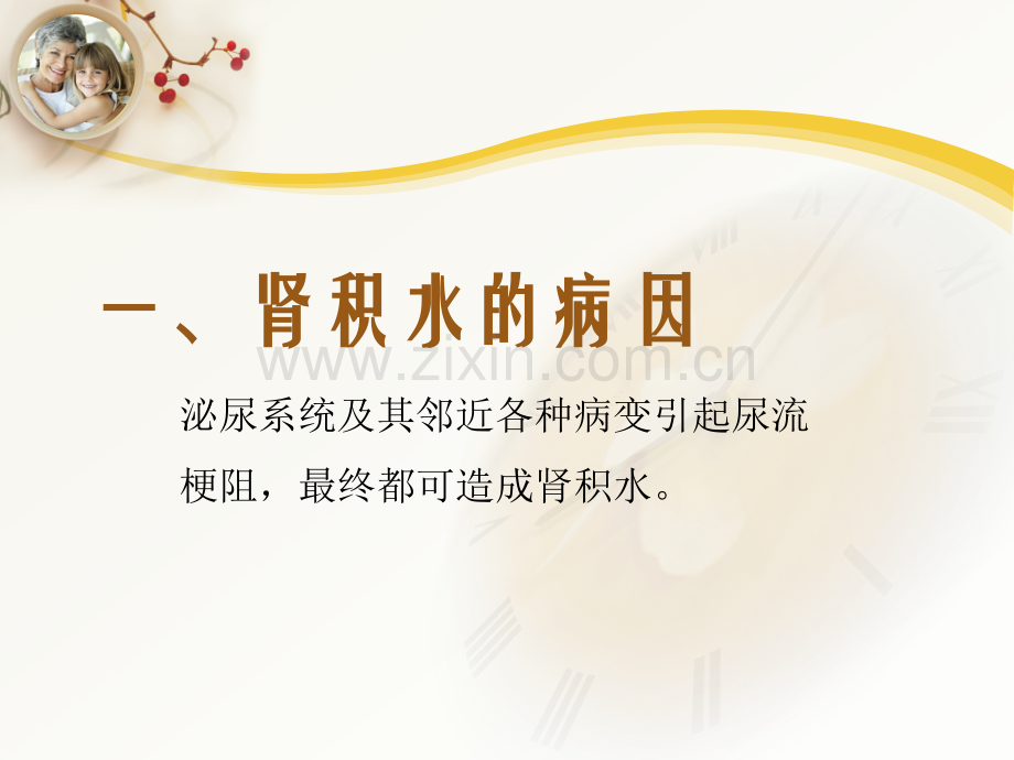 肾积水的护理.ppt_第3页