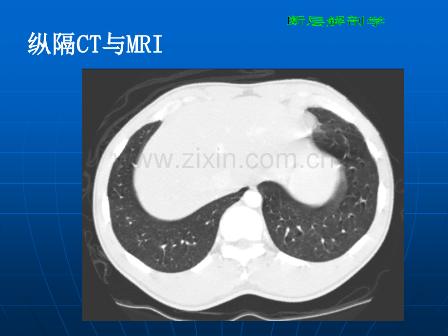 断层解剖学胸部3.ppt_第2页