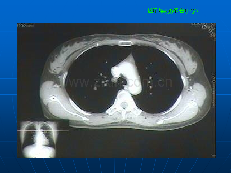 断层解剖学胸部3.ppt_第3页