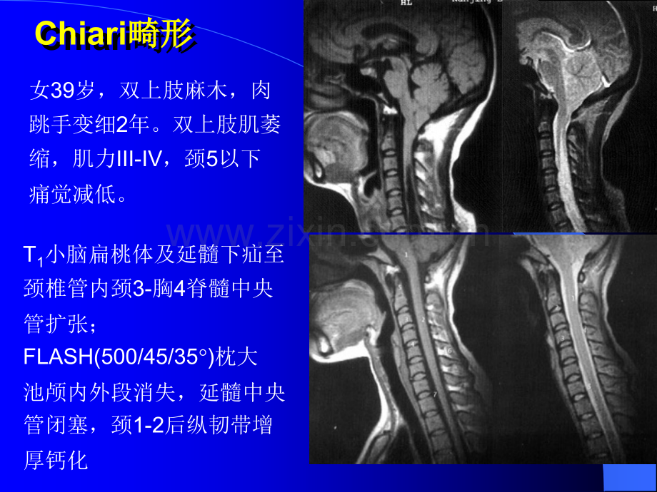 脑部疾病MRI图像A.ppt_第2页