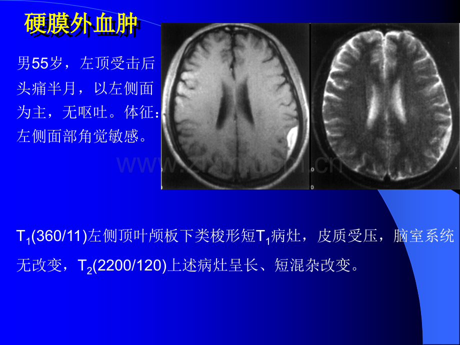 脑部疾病MRI图像A.ppt_第3页