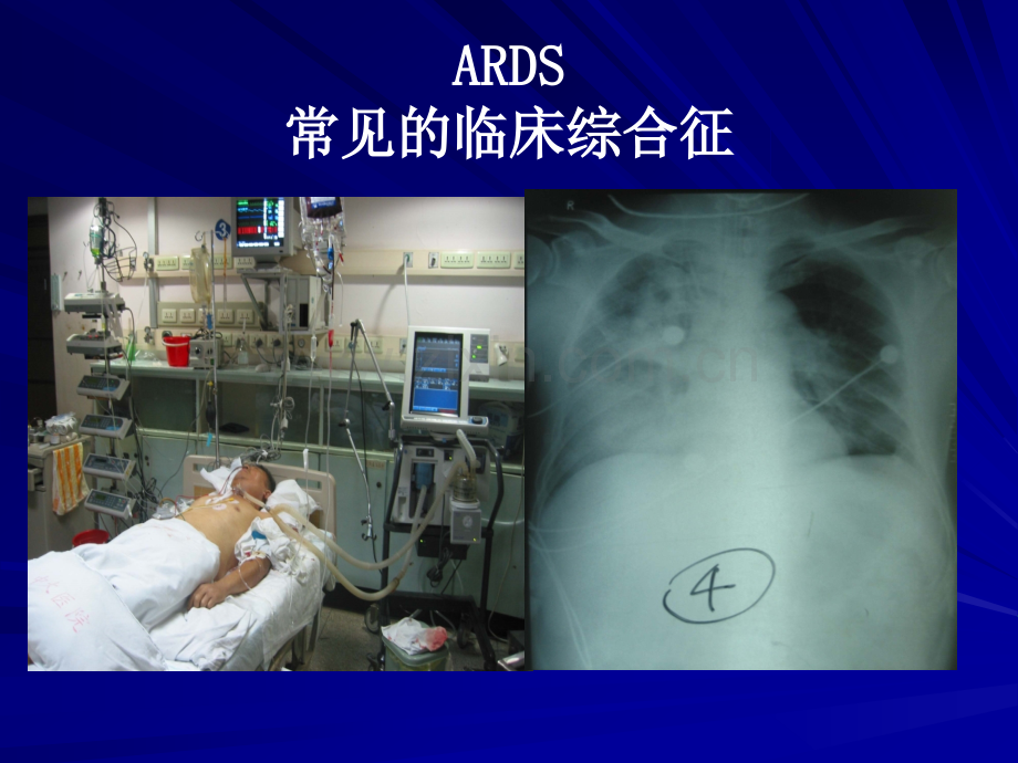 ARDS的治疗策略-.ppt_第3页