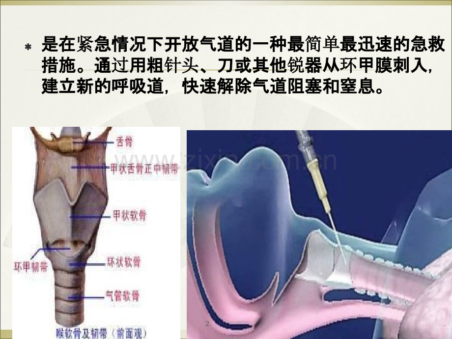 环甲膜穿刺+气道内插管.ppt_第2页