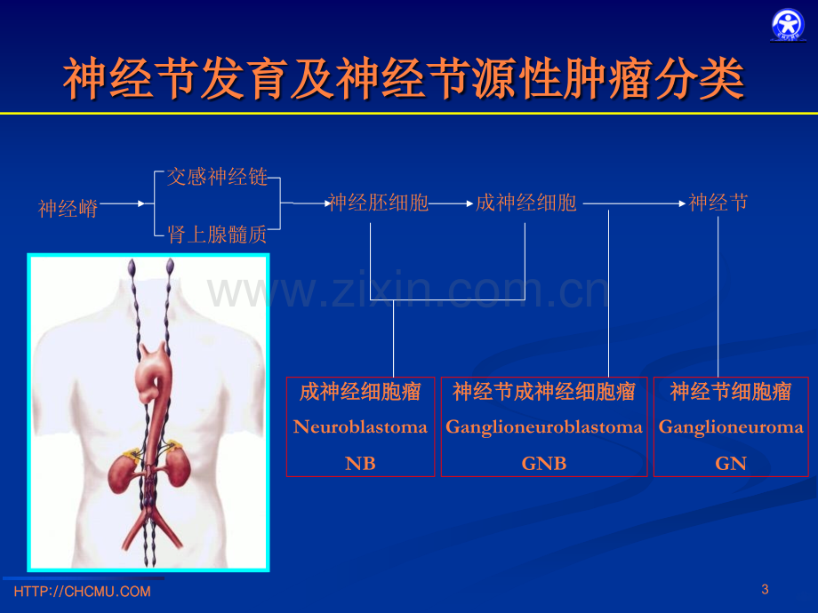 儿童腹膜后神经节源性肿瘤的影像诊断.ppt_第3页