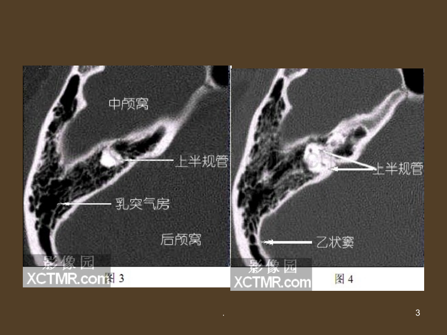 耳部解剖影像解剖应用.ppt_第3页