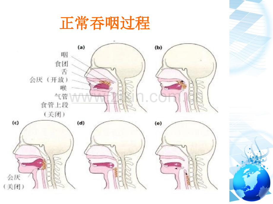 老年人住院期间误吸的预防与处理.ppt_第3页