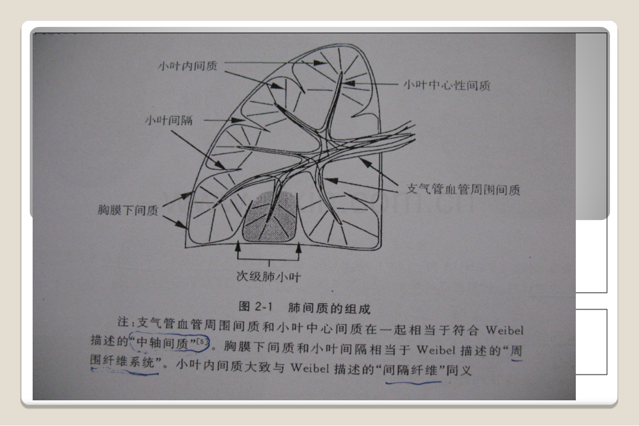 肺特殊CT征象.ppt_第3页