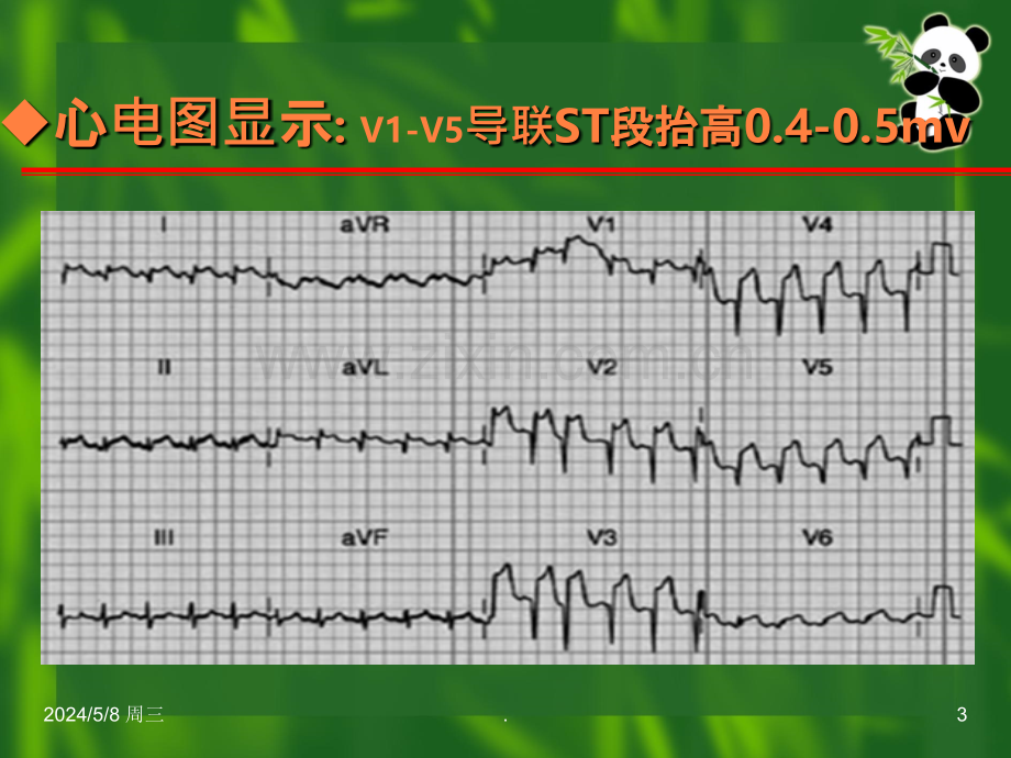 β受体阻滞剂临床应用病例分析.ppt_第3页