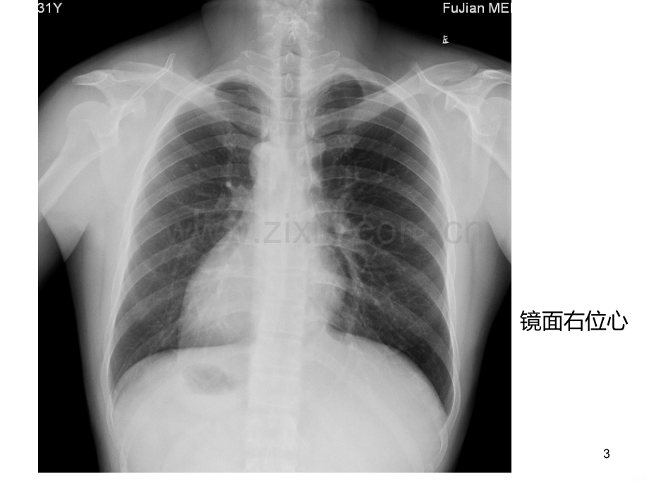 心脏大血管先天异常.ppt_第3页