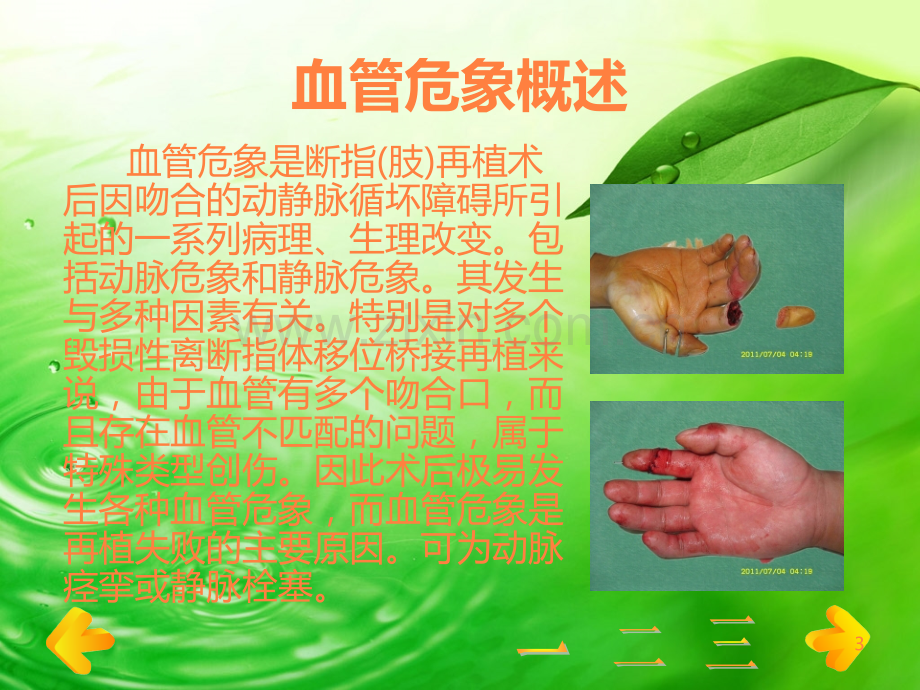 断指再植术后预防血管危象的护理.ppt_第3页