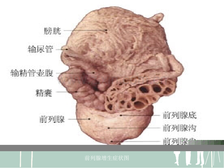 前列腺电切术护理.ppt_第3页