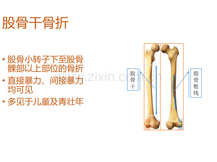 教学查房股骨干骨折课件.ppt_第2页