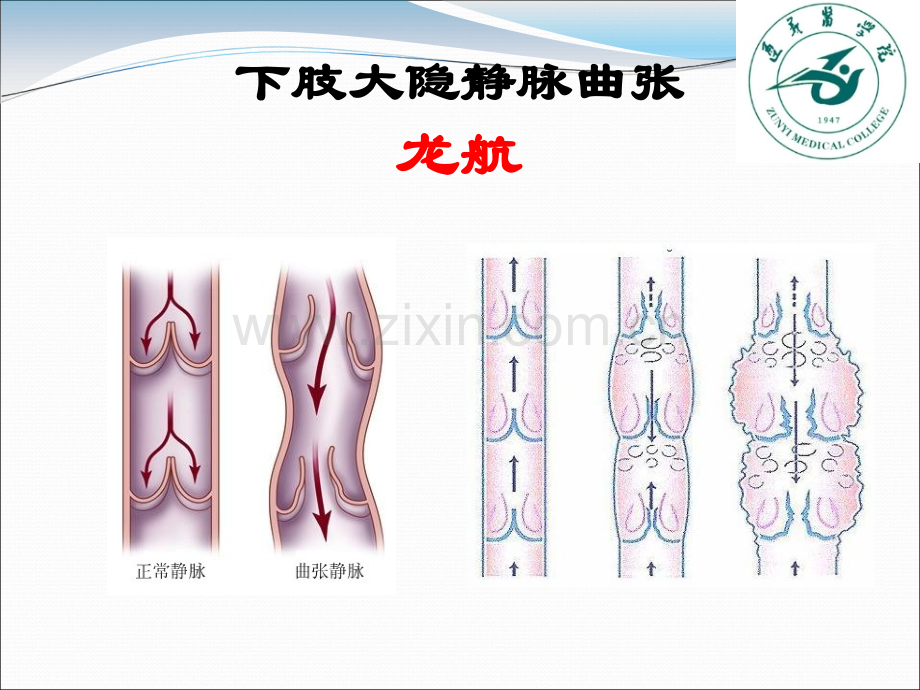 下肢大隐静脉曲张.ppt_第1页