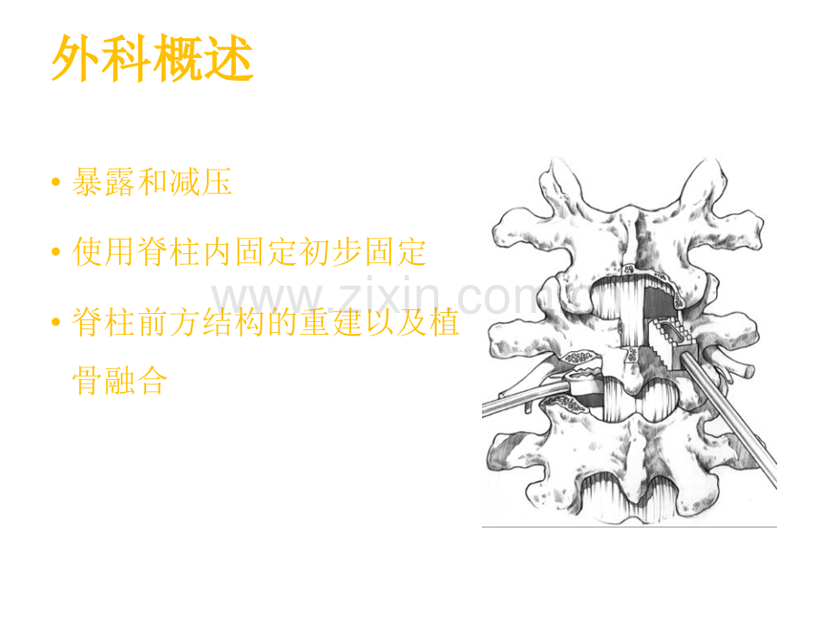 成人腰椎融合术课件.ppt_第3页