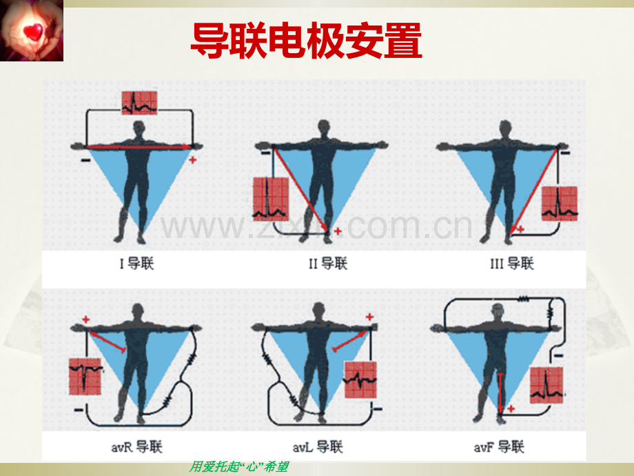 常见心律失常的识别与处理.ppt_第3页