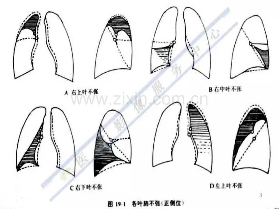 不同部位肺不张的影像特点.ppt_第3页