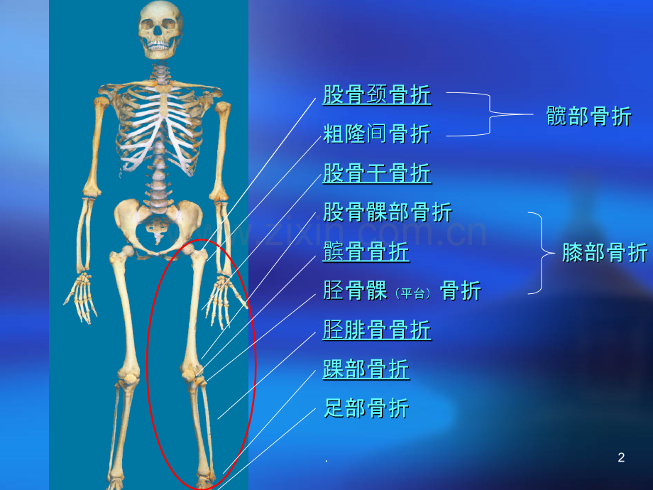 第三节下肢骨折髋部、股骨.ppt_第2页