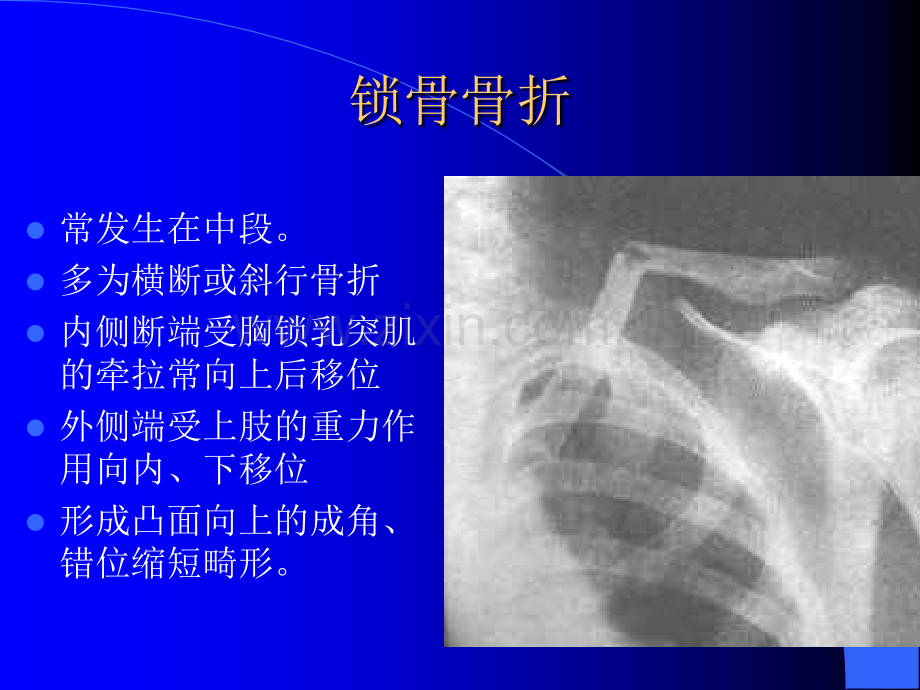 骨科常见疾病的X线表现.ppt_第3页