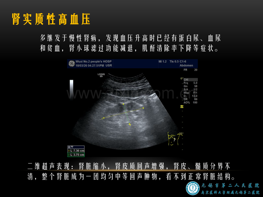 肾性高血压的超声诊断.pptx_第3页