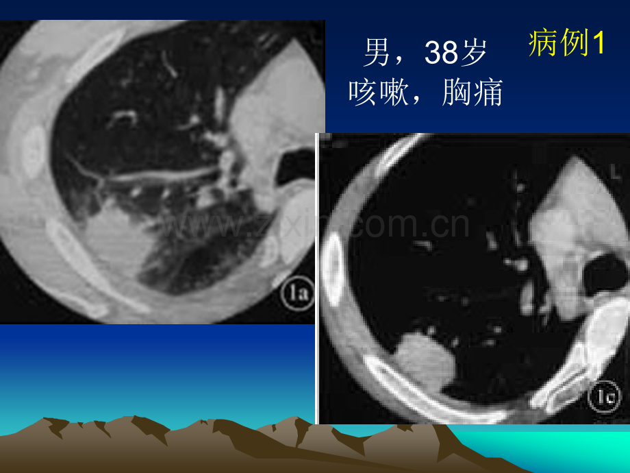 球形肺炎.ppt_第1页