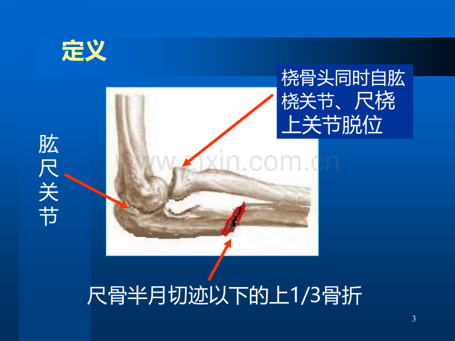 尺骨上骨折并桡骨小头脱位.ppt_第3页