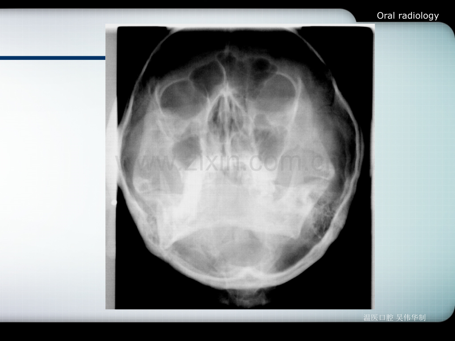 口腔影像诊断学(全)第6章-颌面骨炎症.ppt_第3页