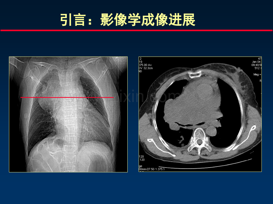 心脑血管疾病影像诊断2014-03-14.ppt_第3页