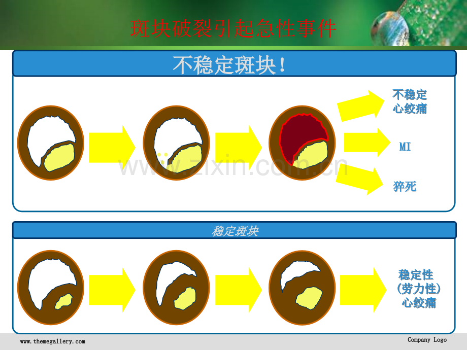 急性心梗诊断治疗新视点.ppt_第3页