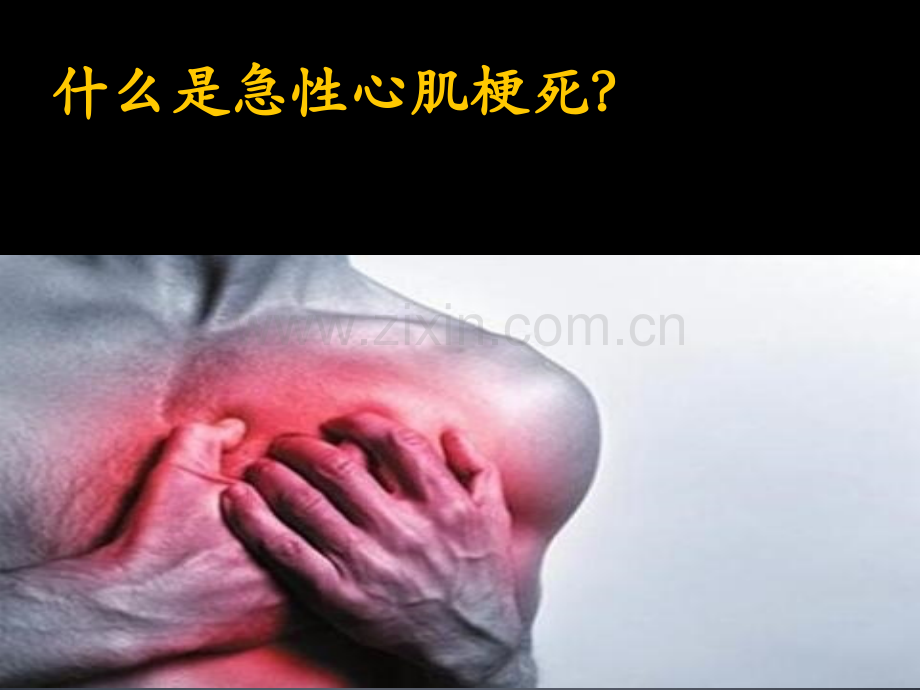 急性心肌梗死的溶栓治疗.ppt_第2页