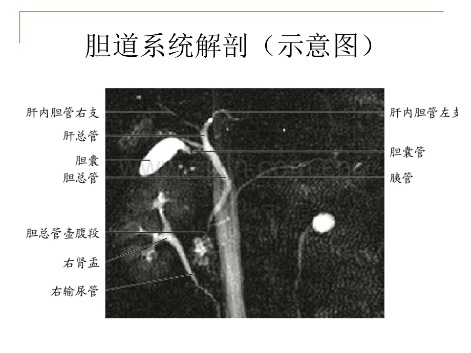 Caroli病的影像表现.ppt_第2页