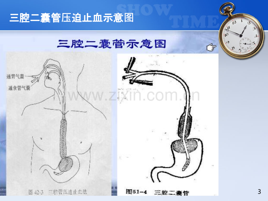 三腔二囊管的护理常规.ppt_第3页