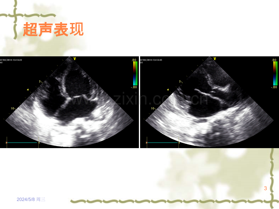 心肌病的超声表现.ppt_第3页