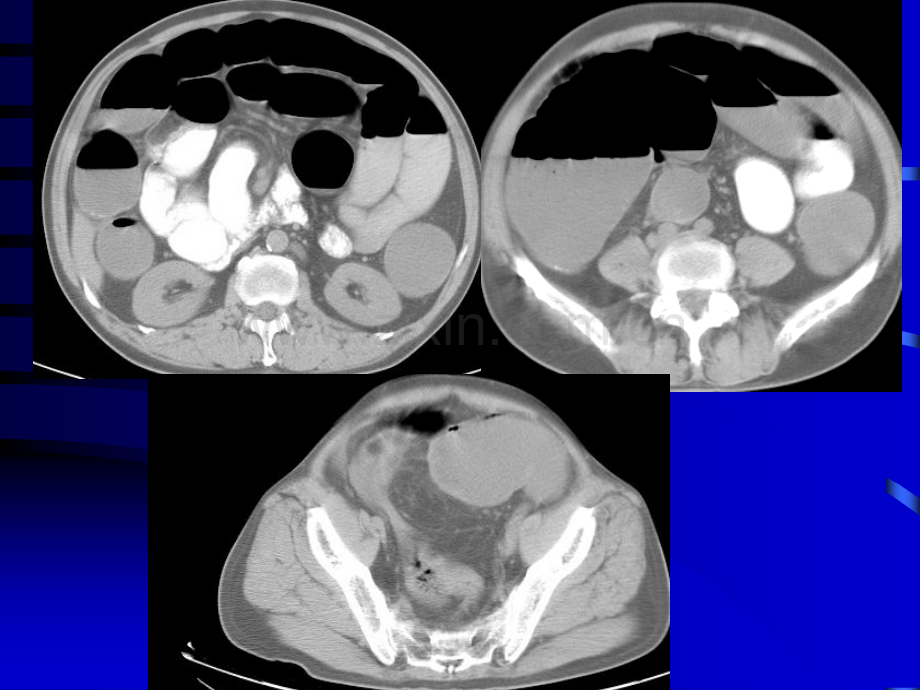 急腹症诊断与治疗.ppt_第3页