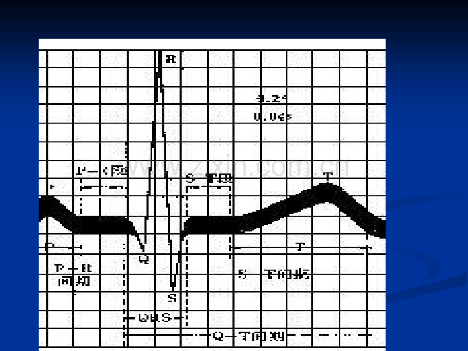 监护仪心电波形的.ppt_第2页