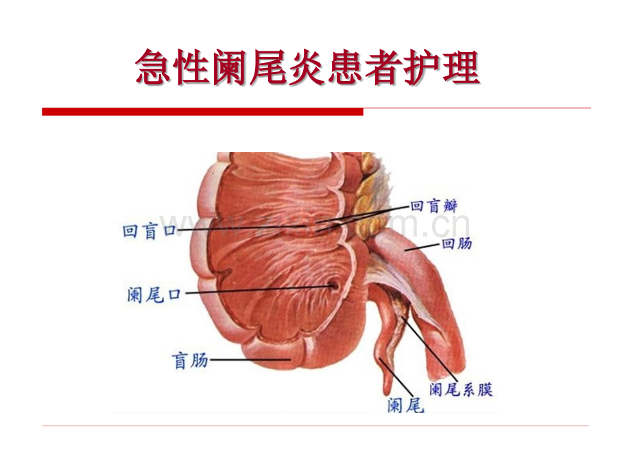 讲急性阑尾炎病人的护理.ppt_第1页