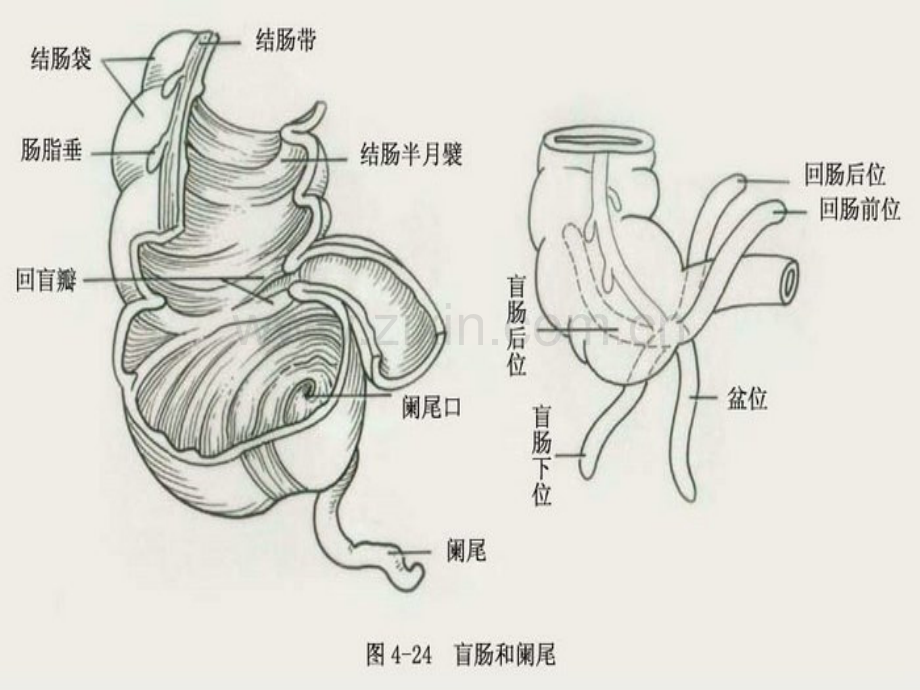 讲急性阑尾炎病人的护理.ppt_第3页