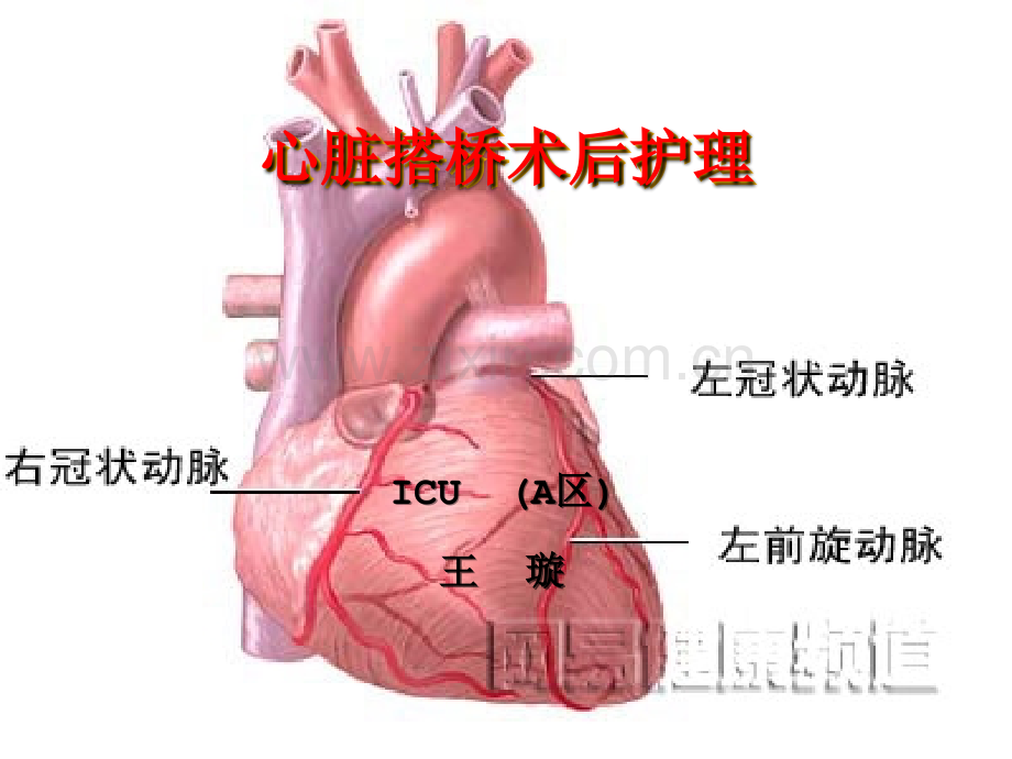 心脏搭桥术后护理.ppt_第1页