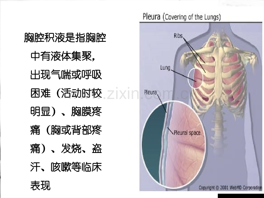 呼吸内科教学查房胸腔积液演示课件.ppt_第2页