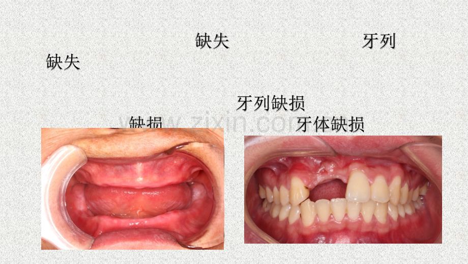 14.牙列缺失和缺损.pptx_第3页