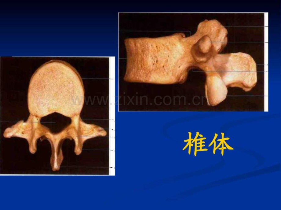 L1椎体爆裂骨折的.pptx_第3页