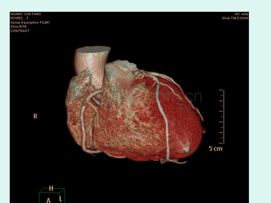 心脏冠状动脉CTA成像.ppt_第3页