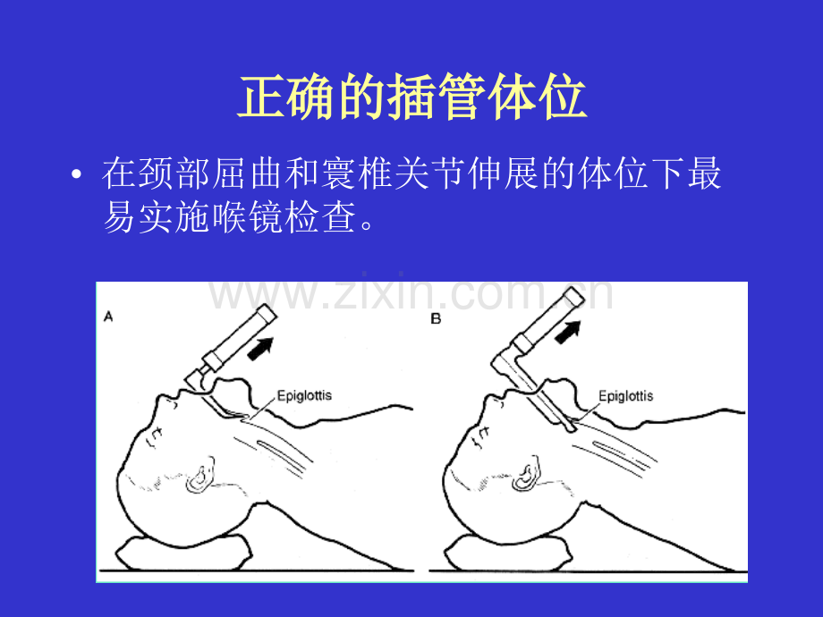 气管插管及困难.ppt_第3页