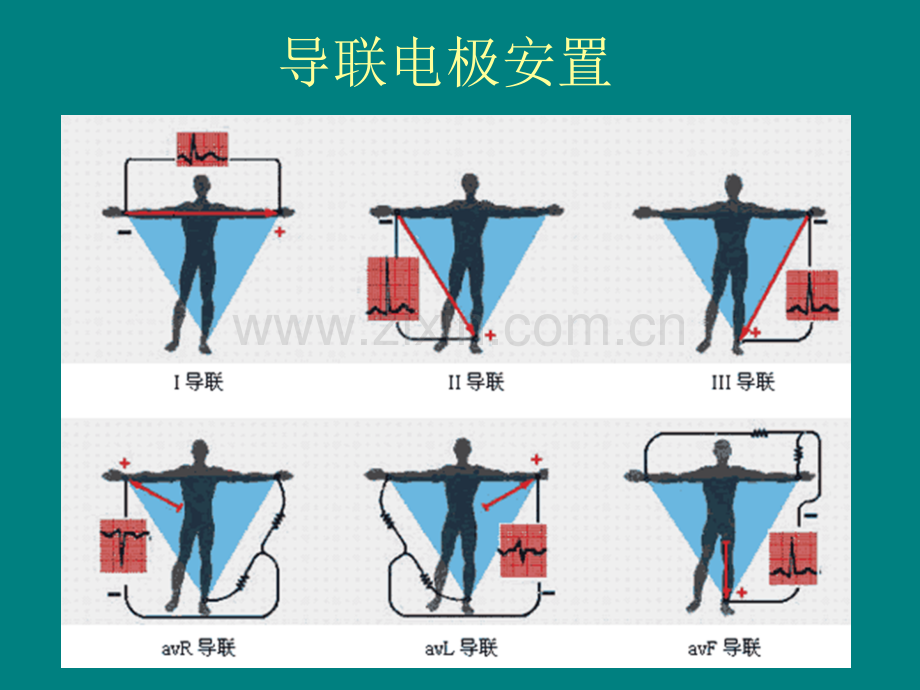 冠心病的心电图表现.ppt_第2页