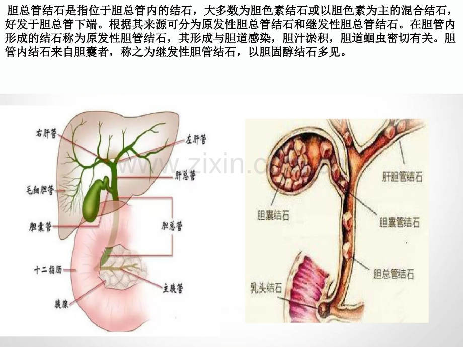 2018胆总管护理查房.ppt_第3页