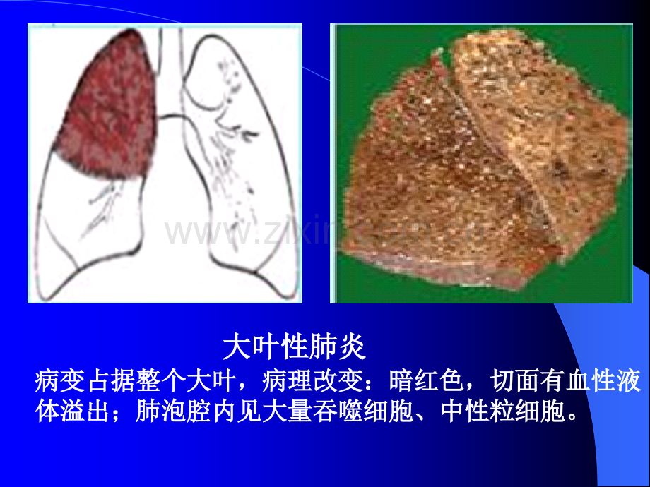 肺部感染.ppt_第3页