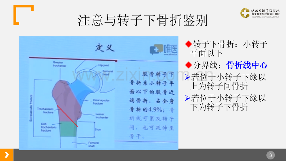 粗隆间骨折治疗体会.ppt_第3页